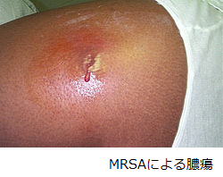 MRSA